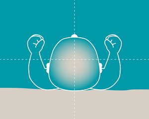 Brachyzephalie bei Säuglingen