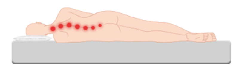 zu harte Matratze, Fehlstellung Wirbelsäule